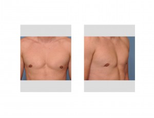 gynecomastia-deformity-dr-barry-eppley-indianapolis