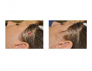 incision-and-closure-for-minimally-invasive-temporal-augmentation