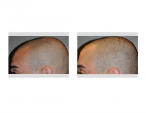 injectable-cranioplasty-left-side-view-dr-barry-eppley-indianapolis1