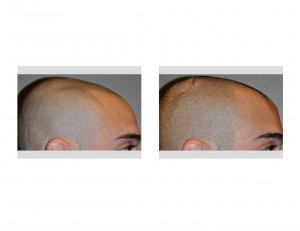 injectable-cranioplasty-right-side-view-dr-barry-eppley-indianapolis