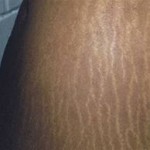 late-stretch-marks-dr-barry-eppley-indianapolis