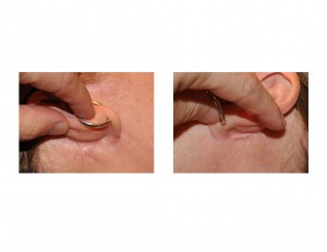 limited-facelift-scar-back-of-ear-dr-barry-eppley-indianapolis