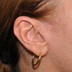 limited-facelift-scar-dr-barry-eppley-indianapolis