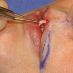 lip-philtral-graft-placement-dr-barry-eppley-indianapolis2