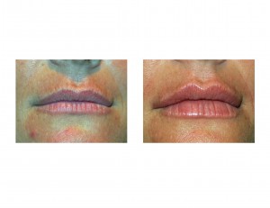 lip-philtroplasty-by-injection-dr-barry-eppley-indianapolis-front-view