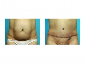 lipoabdominoplasty-dr-barry-eppley-indianapolis