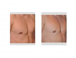 right-chest-implant-removal-and-dermal-fat-grafting2