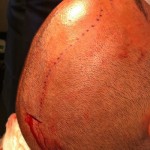 scalp-incision-and-pocket-outline-for-cranioplasty
