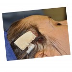 temporal-augmentation-with-dermal-grafts-dr-barry-eppley-indianapolis
