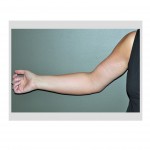 arm-swelling-lymphedema-after-armlift-dr-barry-eppley-indianapolis