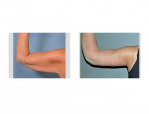 armlift-after-extreme-weight-loss-dr-barry-eppley-indianapolis
