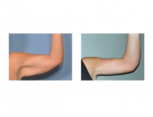 armlift-surgery-dr-barry-eppley-indianapolis
