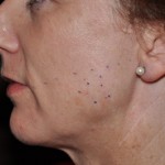 botox-for-clenching-injection-sites-dr-barry-eppley-indianapolis2