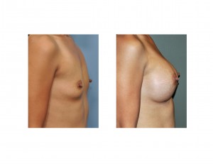 breast-augmentation-in-indian-woman-result-side-view-dr-barry-eppley-indianapolis