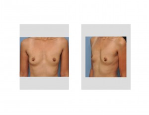 breast-augmentation-in-indian-women-dr-barry-eppley-indianapolis