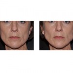 clenching-masseteric-hypertrophy-dr-barry-eppley-indianapolis3