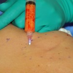 fat-injections-in-breast-lumpectomy-reconstruction-dr-barry-eppley-indianapolis