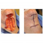female-direct-necklift-closure-dr-barry-eppley-indianapolis