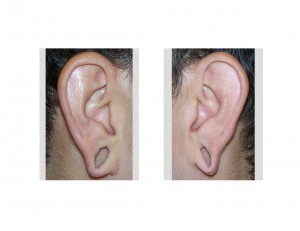 gauged-expanded-earlobes-dr-barry-eppley-indianapolis