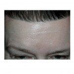 hairline-browlift-scar-dr-barry-eppley-indianapolis