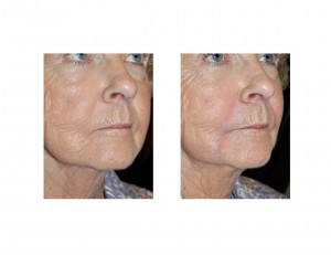 injectable-fillers-in-the-very-aged-face-dr-barry-eppley-indianapolis1