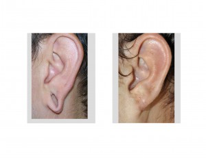 reconstruction-of-the-gauged-earlobe-dr-barry-eppley-indianapolis-left-ear