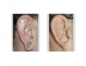 reconstruction-of-the-gauged-earlobe-dr-barry-eppley-indianapolis-right-ear