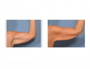 saggy-arms-arm-ptosis-dr-barry-eppley-indianapolis1