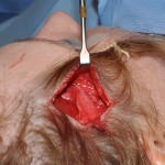 surgical-decompression-for-temporal-headaches-dr-barry-eppley-indianapolis