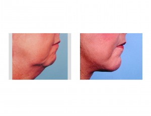 facelift-with-chin-implant-dr-barry-eppley-indianapolis