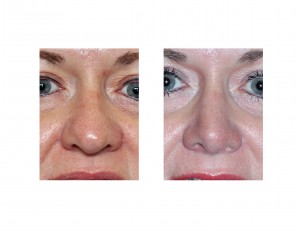 fat-nose-rhinoplasty-front-view-dr-barry-eppley