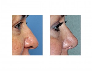 fat-nose-rhinoplasty-side-view-dr-barry-eppley-indianapolis