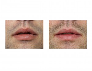 lip-reduction-front-view-dr-barry-eppley