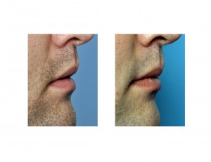 lip-reduction-side-view-dr-barry-eppley