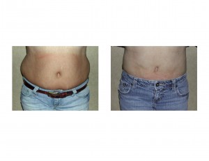 liposuction-for-muffin-tops-dr-barry-eppley-indianapolis