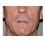 long-upper-lip-in-male-dr-barry-eppley-indianapolis