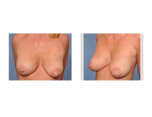 saggy-breasts-for-breast-augmentation-dr-barry-eppley-indianapolis