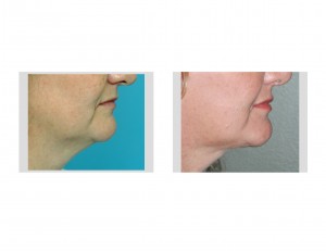 smartlipo-neck-contouring-dr-barry-eppley-indianapolis