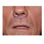 subnasal-lip-lift-in-men-markings-dr-barry-eppley-indianapolis