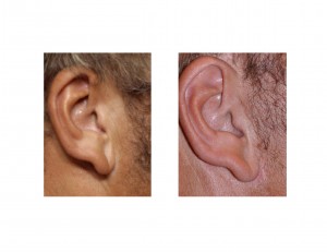 young-male-facelift-scars-dr-barry-eppley-indianapolis
