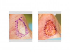 zipper-necklift-markings-dr-barry-eppley-indianapolis