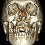 3-d-craniofacial-implant-reconstruction-dr-barry-eppley-indianapolis