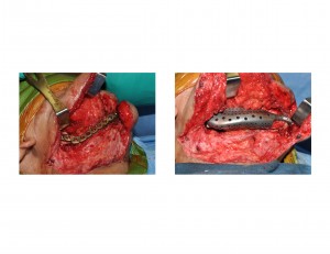 3-d-mandible-implant-replacement-dr-barry-eppley-indianapolis1