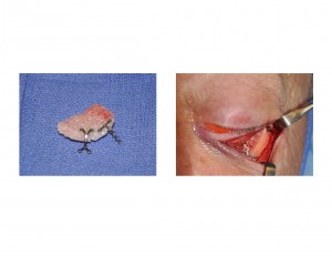 3-d-orbital-implant-reconstruction-dr-barry-eppley-indianapolis