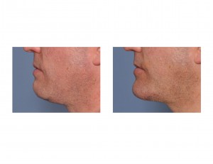 chin-implant-replacement-side-view-dr-barry-eppley-indianapolis