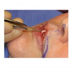 dermal-graft-philtral-enhancement-dr-barry-eppley-indianapolis