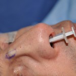 diced-cartilage-injection-dr-barry-eppley-indianapolis