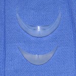 extended-chin-implant-replacing-smaller-chin-implant-dr-barry-eppley-indianapolis