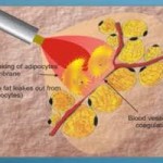 indianapolis-smartlipo-dr-barry-eppley1