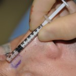 injection-device-for-diced-cartilage-dr-barry-eppley-indianapolis